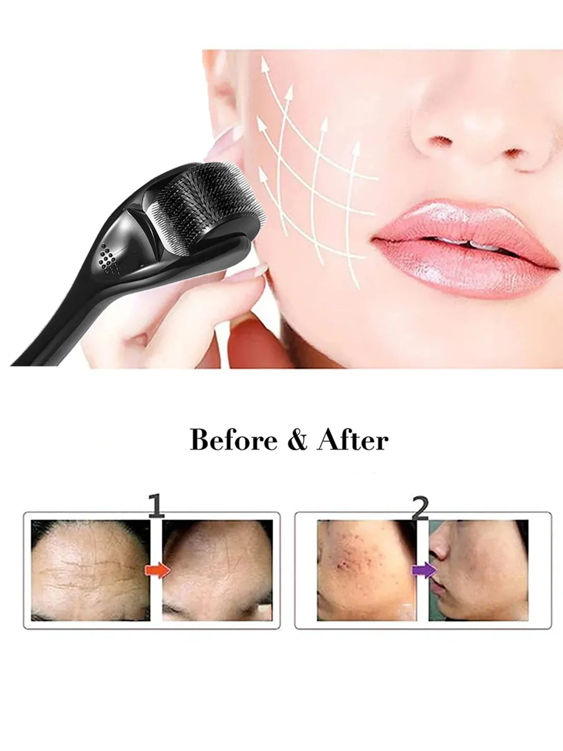 Microneedle Rollers Dermatological Derma